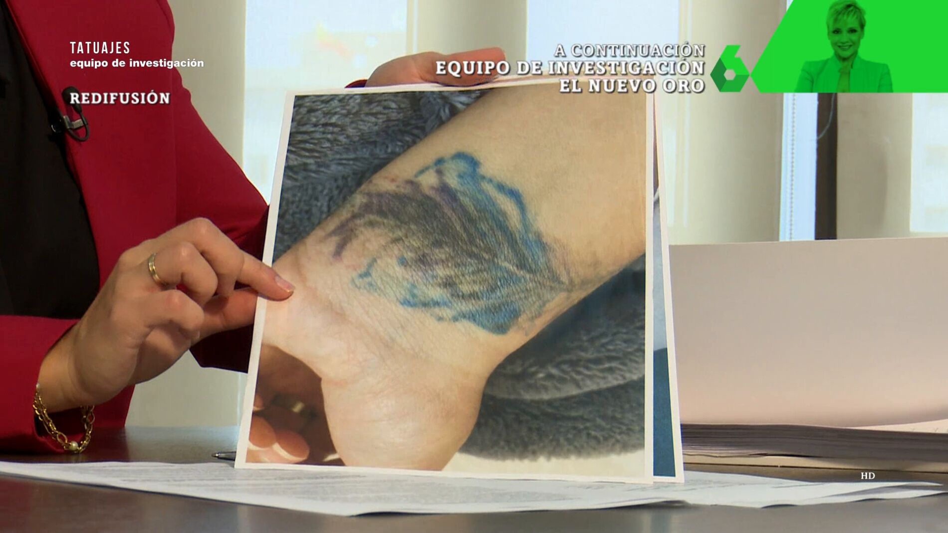 Las "nefastas" consecuencias del borrado de un tatuaje con láser: "Es una quemadura y le quedará
